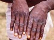 Annoba: Mutum 67 Sun Kamu Da Cutar Kyandar Biri a Jihohi 23 Na Najeriya download (8)