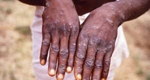 Annoba: Mutum 67 Sun Kamu Da Cutar Kyandar Biri a Jihohi 23 Na Najeriya download (8)